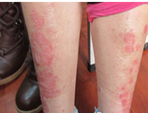 女性牛皮癣病情受例假影响吗?