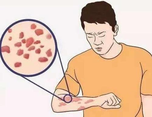 湿毒会引起荨麻疹症状损害吗?