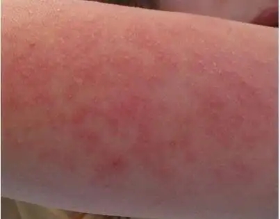 皮肤过敏除了红疹还有哪些表现?