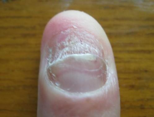 灰指甲不治疗后果严重吗?