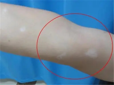 白癜风患者能吃牛羊肉吗?