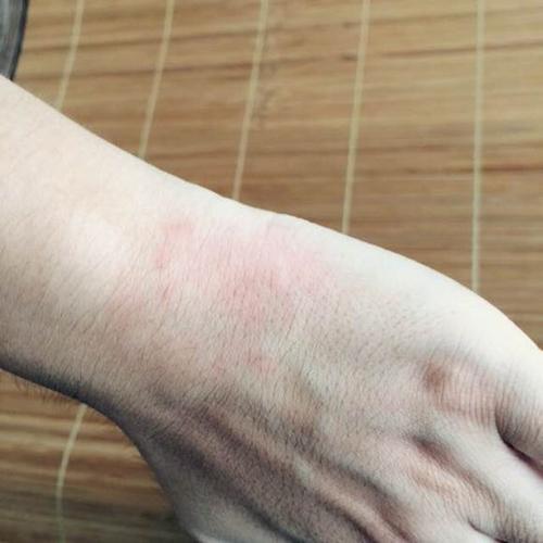 荨麻疹会导致手指出现肿胀吗?