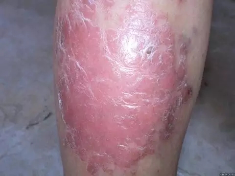 牛皮癣患者可以多洗澡缓解干燥吗?