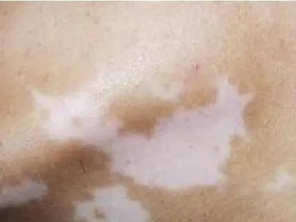 中医上白癜风都有哪些原因如何护理好呢?