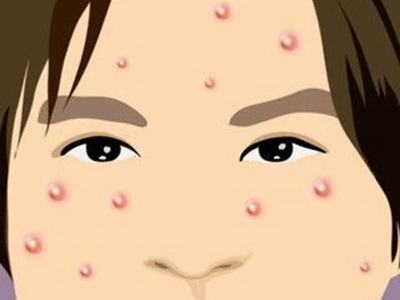 青春痘是因为毛孔堵塞引起的吗?