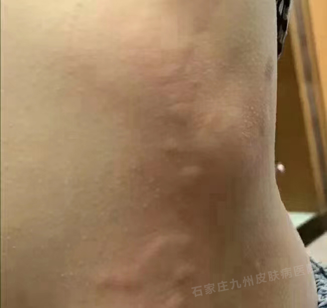 荨麻疹引起的风团是凸出来的吗?