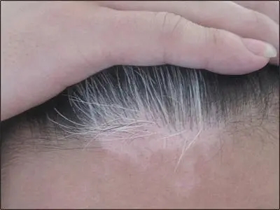 皮肤过敏会引起白癜风复发吗?