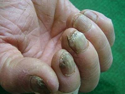 灰指甲越来越厚是变得严重了吗?