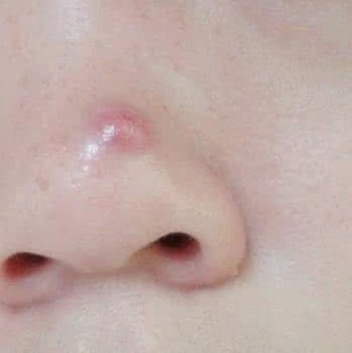 皮肤出油是不是容易长青春痘?