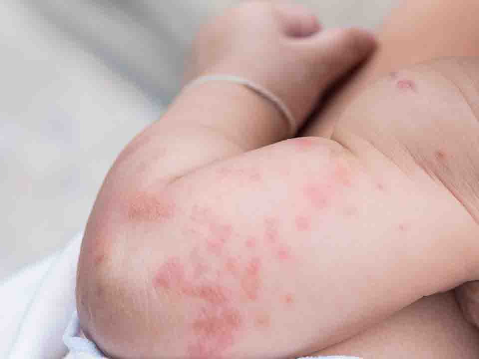 银屑病患者如何提高免疫力?